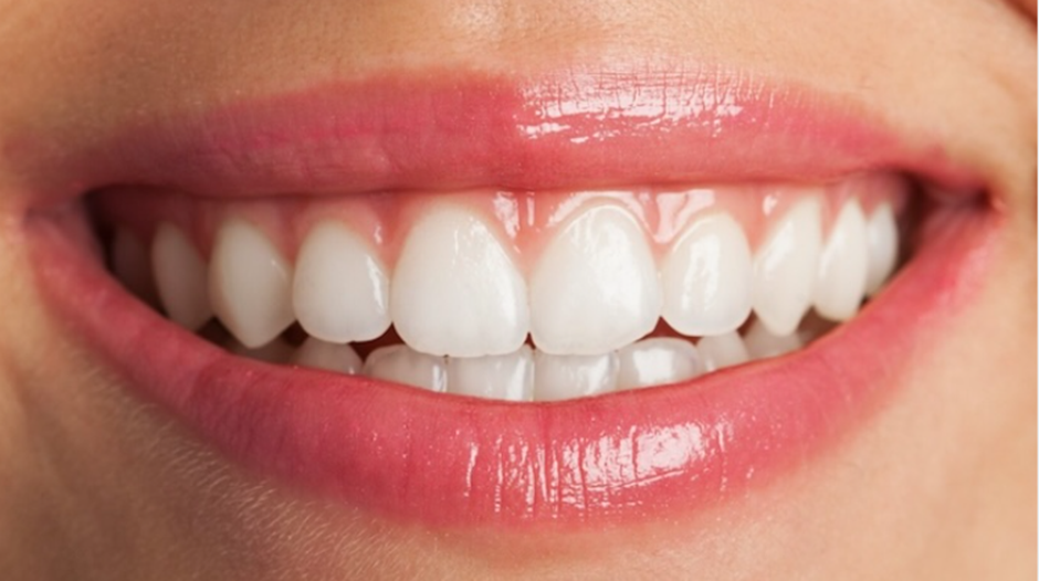 The Tartar Takedown: 7 Natural Home Remedies for Your Teeth